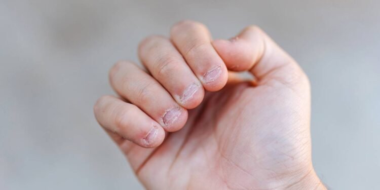 Morder as unhas pode indicar ansiedade e merece atenção