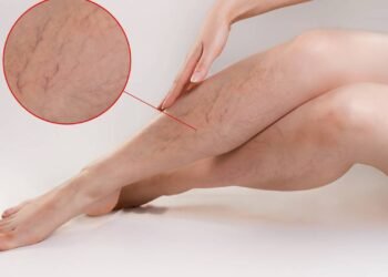 Assassino de varizes! Esse remédio caseiro apaga varizes como uma borracha