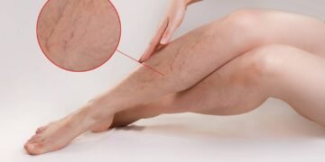 Assassino de varizes! Esse remédio caseiro apaga varizes como uma borracha