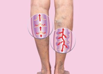 Cinco bebidas mágicas para desentupir veias e artérias