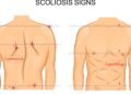 O que realmente causa escoliose e quando ela exige tratamento