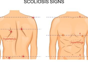 O que realmente causa escoliose e quando ela exige tratamento