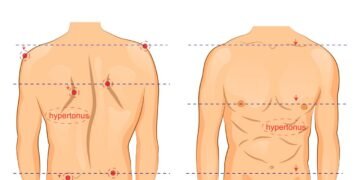 O que realmente causa escoliose e quando ela exige tratamento