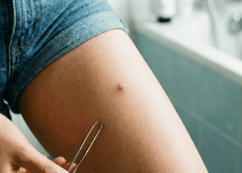 Sofrendo com pelos encravados? Entenda como desobstruir os poros da virilha de forma segura e fácil