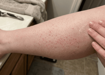 Pele lisinha e sem irritação: como prevenir e tratar pelos encravados em casa