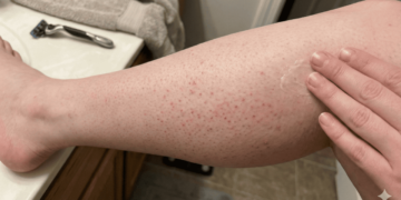 Pele lisinha e sem irritação: como prevenir e tratar pelos encravados em casa