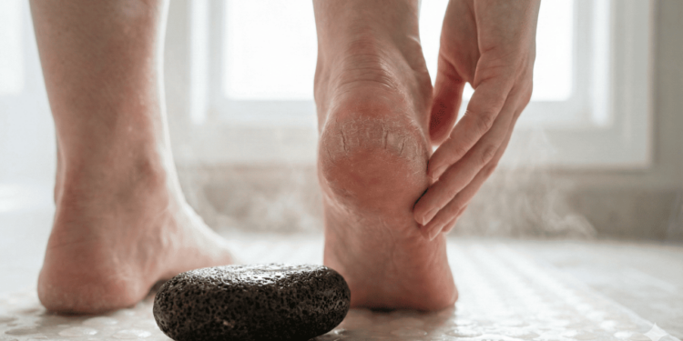 Lixar o calcanhar com pedra-pomes durante o banho, com a pele bem amolecida, parece mais fácil, mas pode ser arriscado.