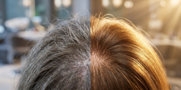 Queda de cabelo não é falta de vitamina: dermatologista alerta para erro que pode atrasar diagnóstico grave