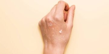 O que realmente causa pele ressecada e como evitar