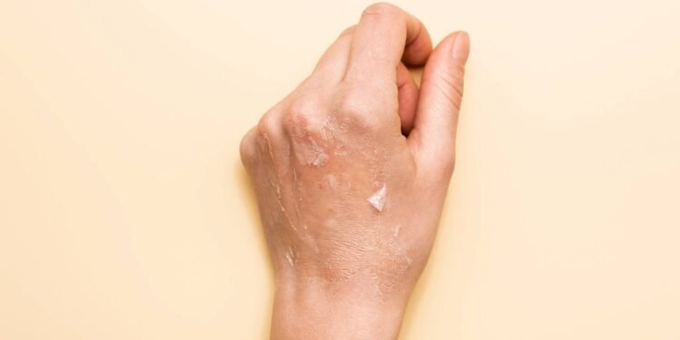 O que realmente causa pele ressecada e como evitar - Créditos: depositphotos.com / VadimVasenin