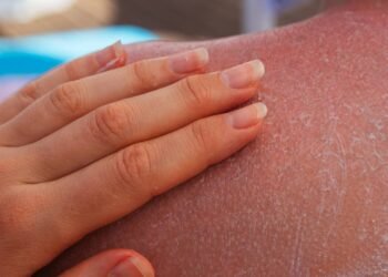 Como proteger a pele do calor e evitar assaduras mesmo em dias de muito suor e movimento