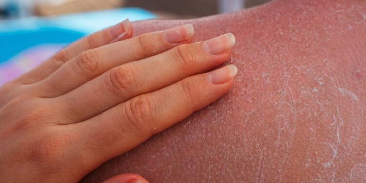 Para prevenir assaduras no calor, a combinação de higiene adequada e roupas apropriadas costuma funcionar muito bem - Créditos: depositphotos.com / Kinderkz