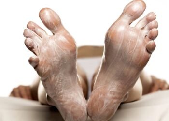 Calcanhar rachado incomoda? Veja como ureia 10% devolve conforto e maciez