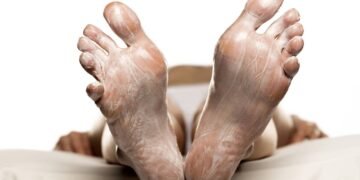 Calcanhar rachado incomoda? Veja como ureia 10% devolve conforto e maciez