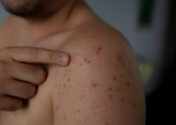 O risco mais ignorado que pode trazer o sarampo de volta