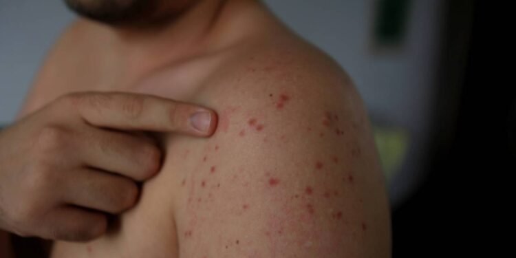 sarampo - Créditos: depositphotos.com / joasouza