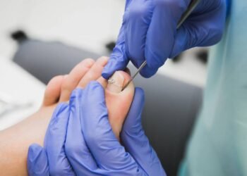 Dor, inchaço e pus na unha? Entenda como tratar a infecção e recuperar a saúde dos seus pés