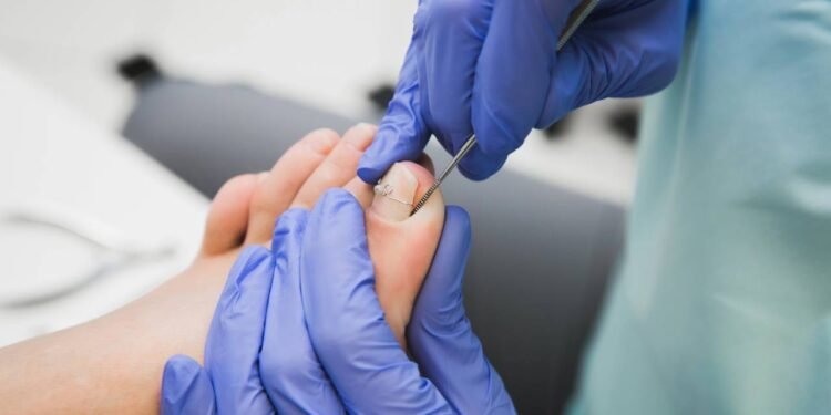 A expressão unha encravada descreve quando a borda da unha do pé começa a pressionar ou furar a pele ao lado - Créditos: depositphotos.com / bondarech