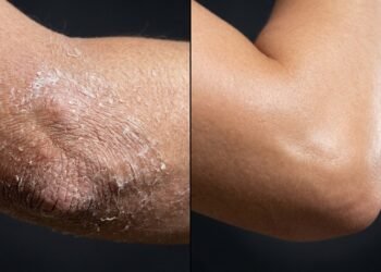 Cotovelos rachados nunca mais: a mistura caseira com 3 ingredientes que hidrata e suaviza já na primeira aplicação