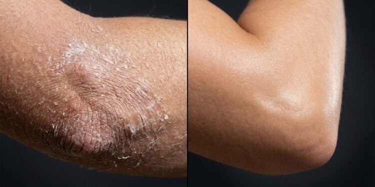 Cotovelos rachados nunca mais: a mistura caseira com 3 ingredientes que hidrata e suaviza já na primeira aplicação