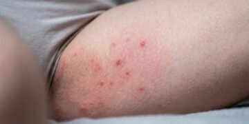 Você depila a virilha e depois sofre com ardência e bolinhas? O problema pode estar nesse detalhe simples