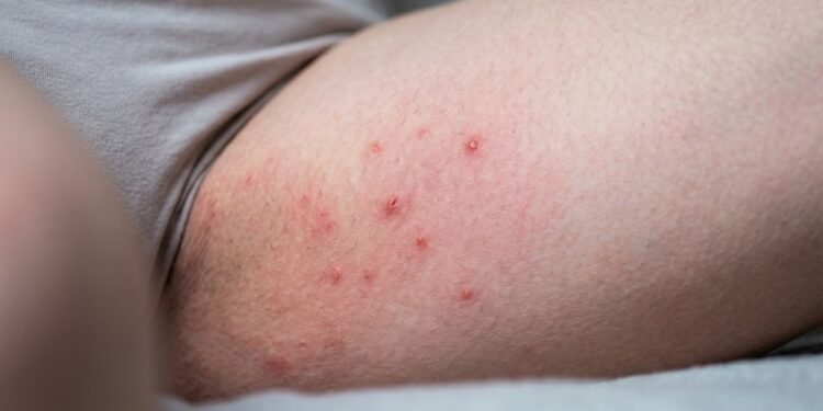 Você depila a virilha e depois sofre com ardência e bolinhas? O problema pode estar nesse detalhe simples