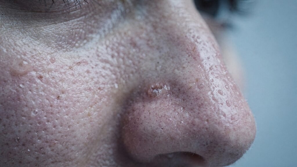 Espinhas na testa não aparecem por acaso: veja o que causa acne nessa região e como controlar rápido sem piorar a pele