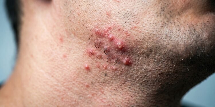 Quase todo mundo comete esse erro com pelo encravado e só percebe quando a pele já está marcada