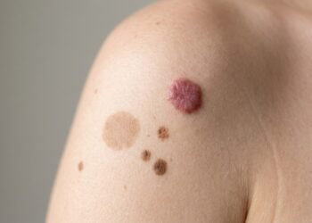 Marca de nascença: o que ela representa na pele, na espiritualidade e quando merece atenção médica imediata