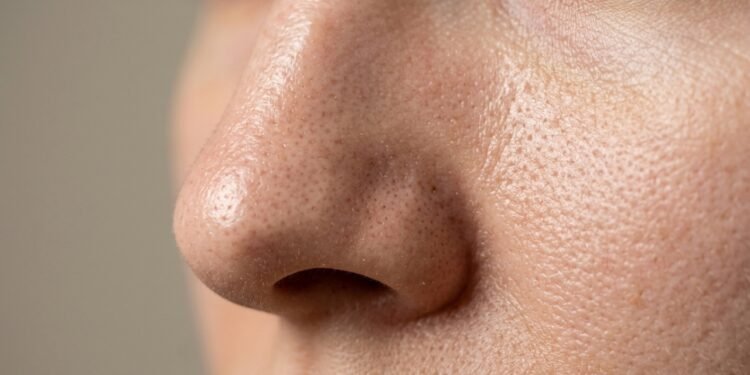 Pele oleosa não é o problema que muita gente imagina e pode revelar outro desequilíbrio