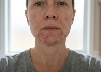 Dois ativos famosos para acne e marcas de espinhas: veja se você está usando corretamente e qual escolher