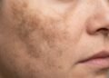 Melasma piorando mesmo com cuidado pode ser por algo simples na sua rotina