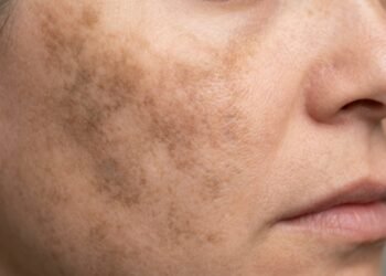 Melasma piorando mesmo com cuidado pode ser por algo simples na sua rotina