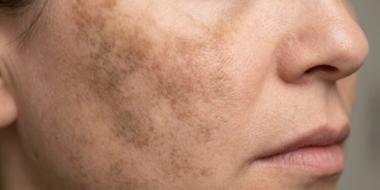 Melasma piorando mesmo com cuidado pode ser por algo simples na sua rotina