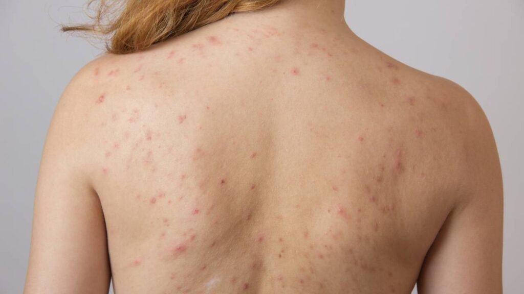 Tratar acne nas costas