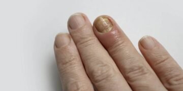 unha da mão encravada_1775586921881