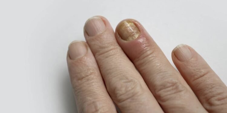 unha da mão encravada_1775586921881