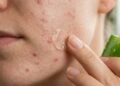 As plantas mais conhecidas para tratar acne leve e equilibrar pele oleosa naturalmente