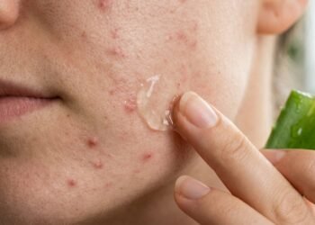 As plantas mais conhecidas para tratar acne leve e equilibrar pele oleosa naturalmente