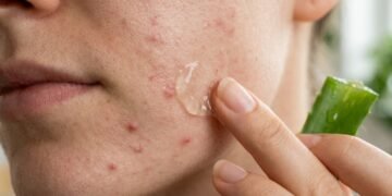 As plantas mais conhecidas para tratar acne leve e equilibrar pele oleosa naturalmente