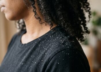 Como acabar com a caspa de forma natural e melhorar a saúde do couro cabeludo