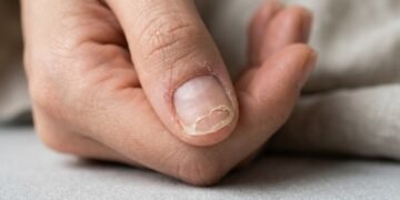 Adeus unhas quebradiças: a receita com cravo na base que promete fortalecer desde a raiz