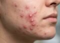 O hábito comum antes de dormir que pode estar deixando sua acne inflamada mais agressiva