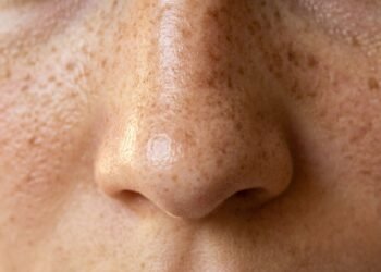 O que causa sardas e quais cuidados ajudam a evitar novas manchas na pele