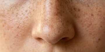 O que causa sardas e quais cuidados ajudam a evitar novas manchas na pele