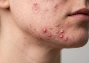 O erro comum que piora a acne inflamada e como tratar a pele em casa