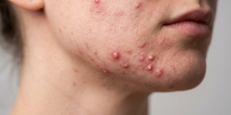 O erro comum que piora a acne inflamada e como tratar a pele em casa