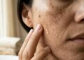 Manchas na pele: a rotina diária que ajuda a corrigir e a prevenir o seu reaparecimento