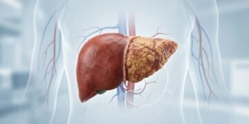 Cirrose hepática mostra como a cicatrização do fígado pode evoluir para doença grave silenciosa
