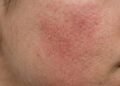 Dermatologista explica de que forma você pode estar machucando sua pele na hora de lavar